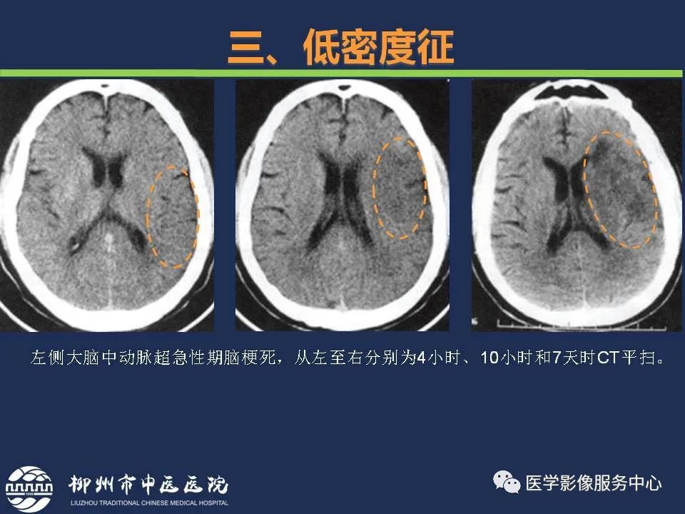 影像PPT - 【PPT】超早期脑梗死CT征象-30