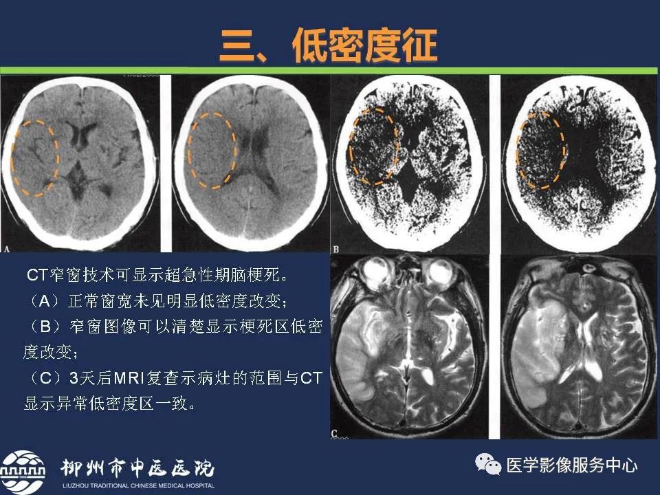 影像PPT - 【PPT】超早期脑梗死CT征象-31