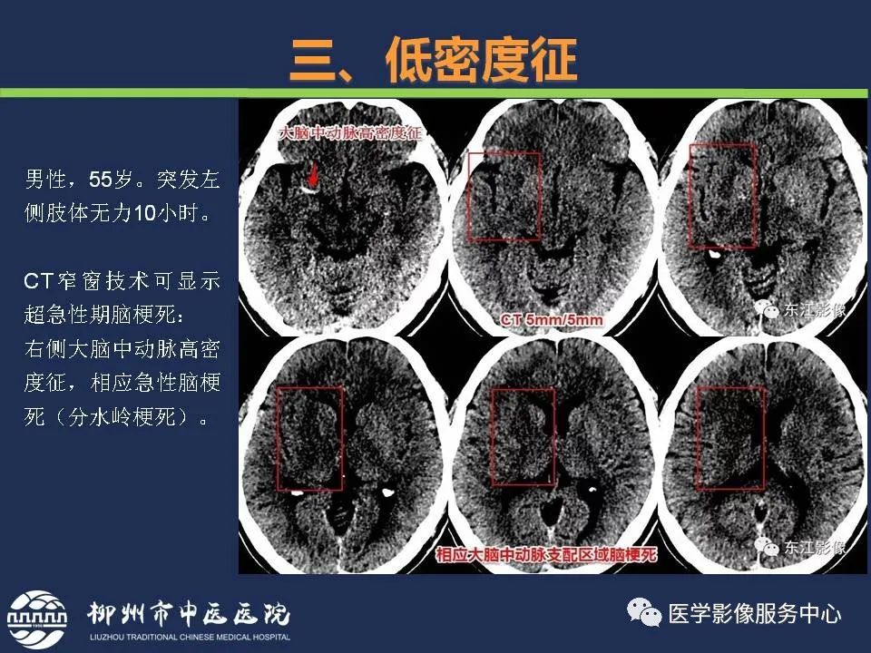 影像PPT - 【PPT】超早期脑梗死CT征象-32