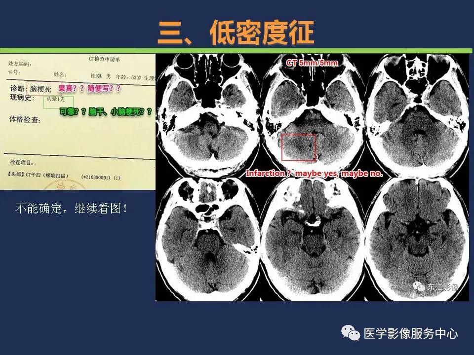 影像PPT - 【PPT】超早期脑梗死CT征象-33