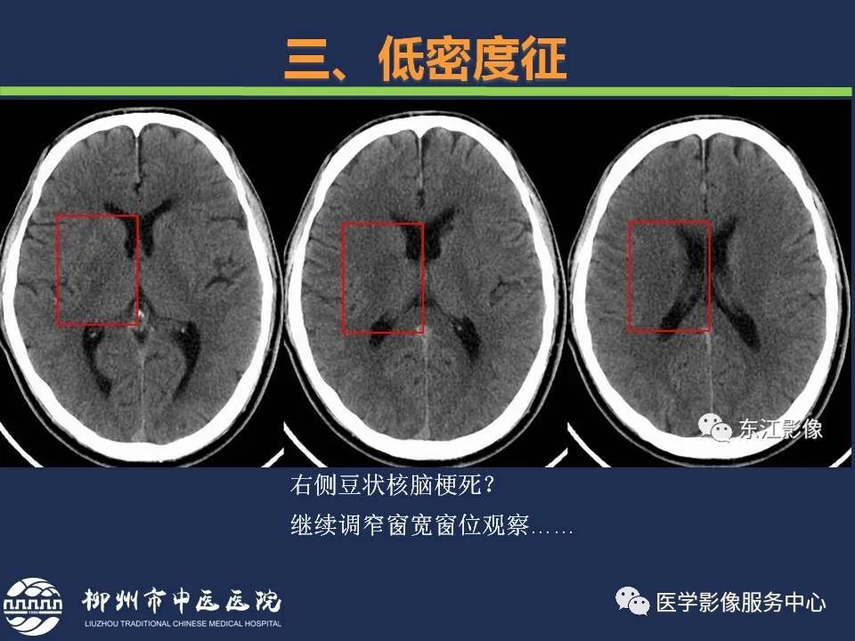 影像PPT - 【PPT】超早期脑梗死CT征象-34