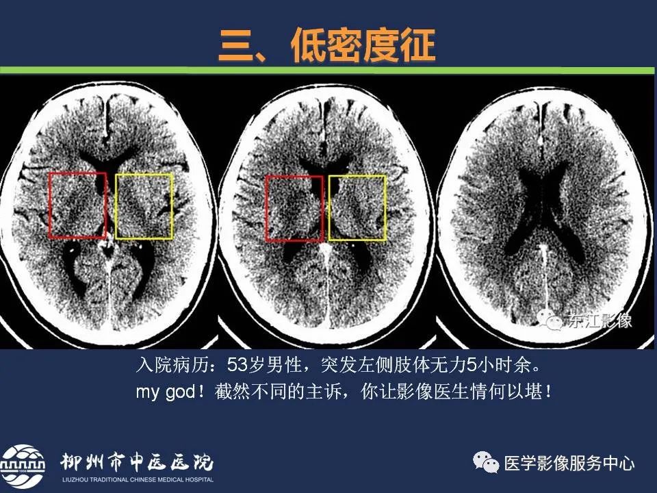 影像PPT - 【PPT】超早期脑梗死CT征象-35