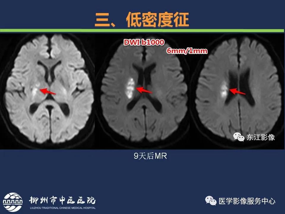 影像PPT - 【PPT】超早期脑梗死CT征象-36