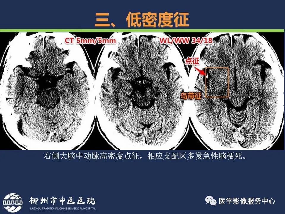 影像PPT - 【PPT】超早期脑梗死CT征象-37