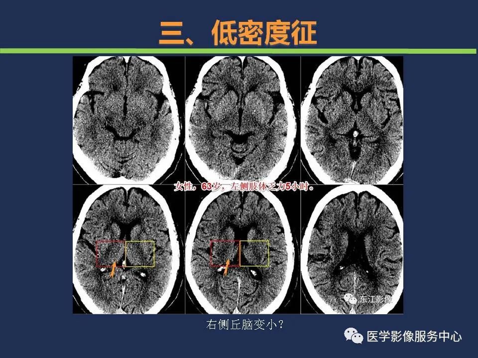 影像PPT - 【PPT】超早期脑梗死CT征象-38