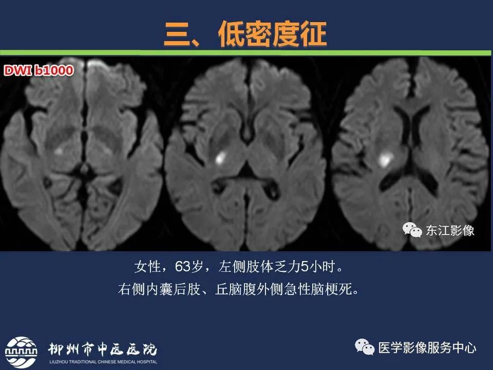 影像PPT - 【PPT】超早期脑梗死CT征象-39