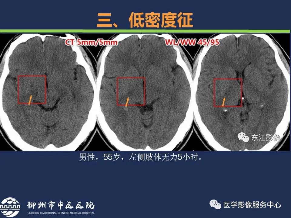 影像PPT - 【PPT】超早期脑梗死CT征象-40