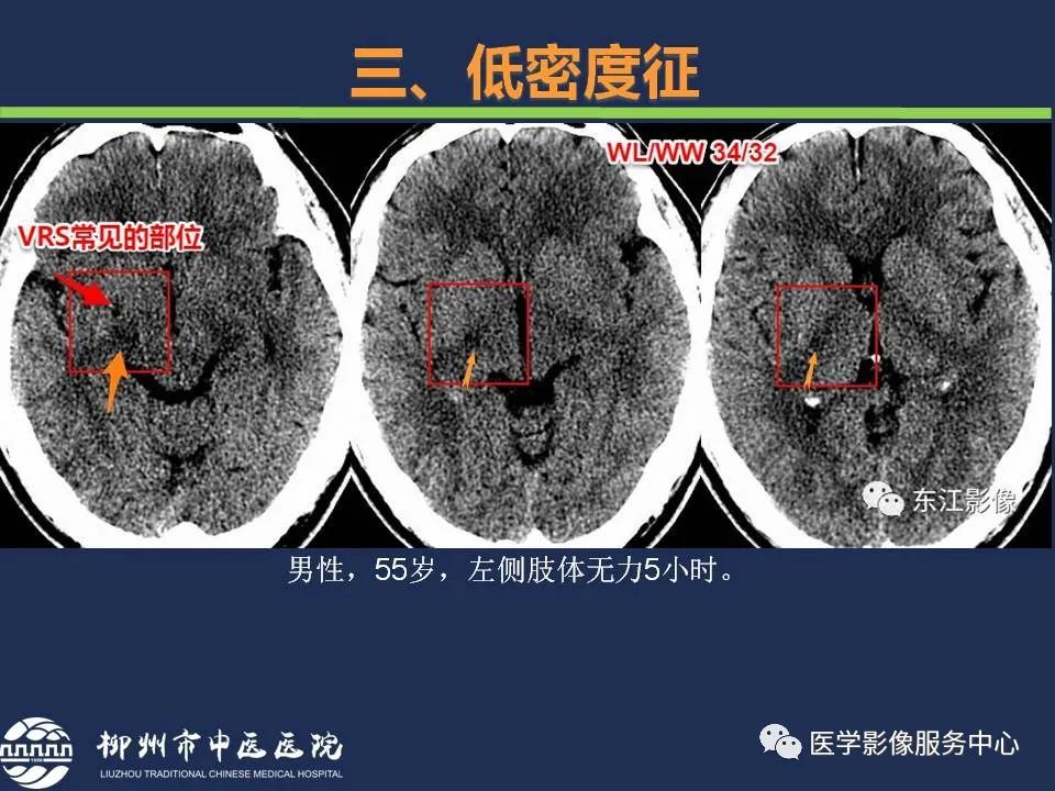 影像PPT - 【PPT】超早期脑梗死CT征象-41