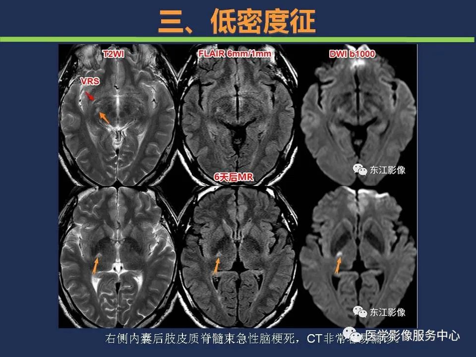 影像PPT - 【PPT】超早期脑梗死CT征象-42