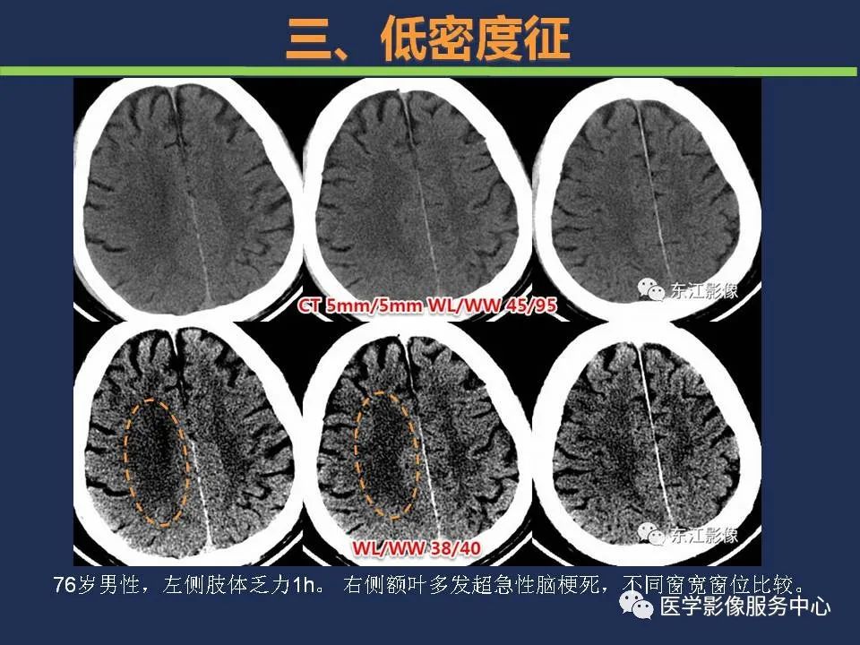 影像PPT - 【PPT】超早期脑梗死CT征象-43