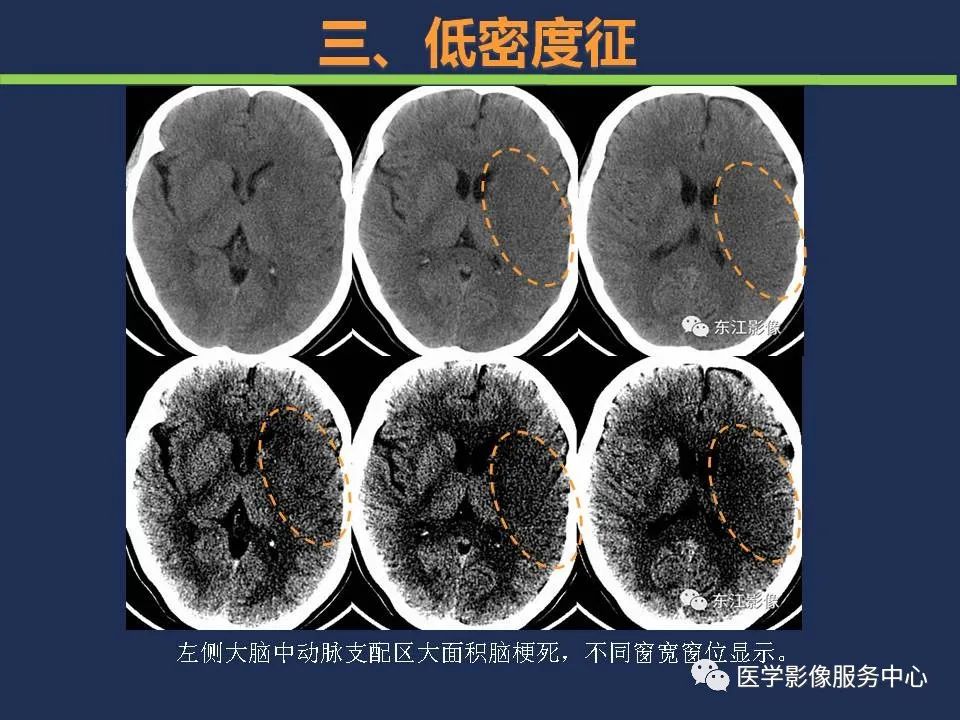 影像PPT - 【PPT】超早期脑梗死CT征象-44
