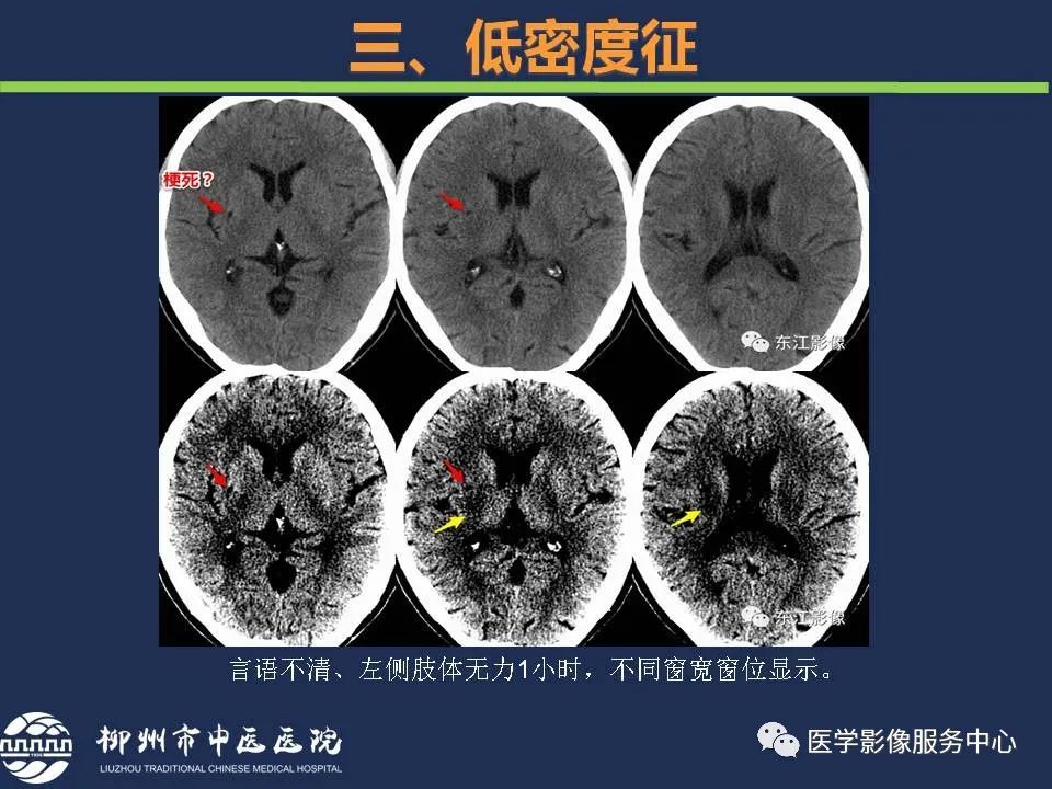 影像PPT - 【PPT】超早期脑梗死CT征象-45