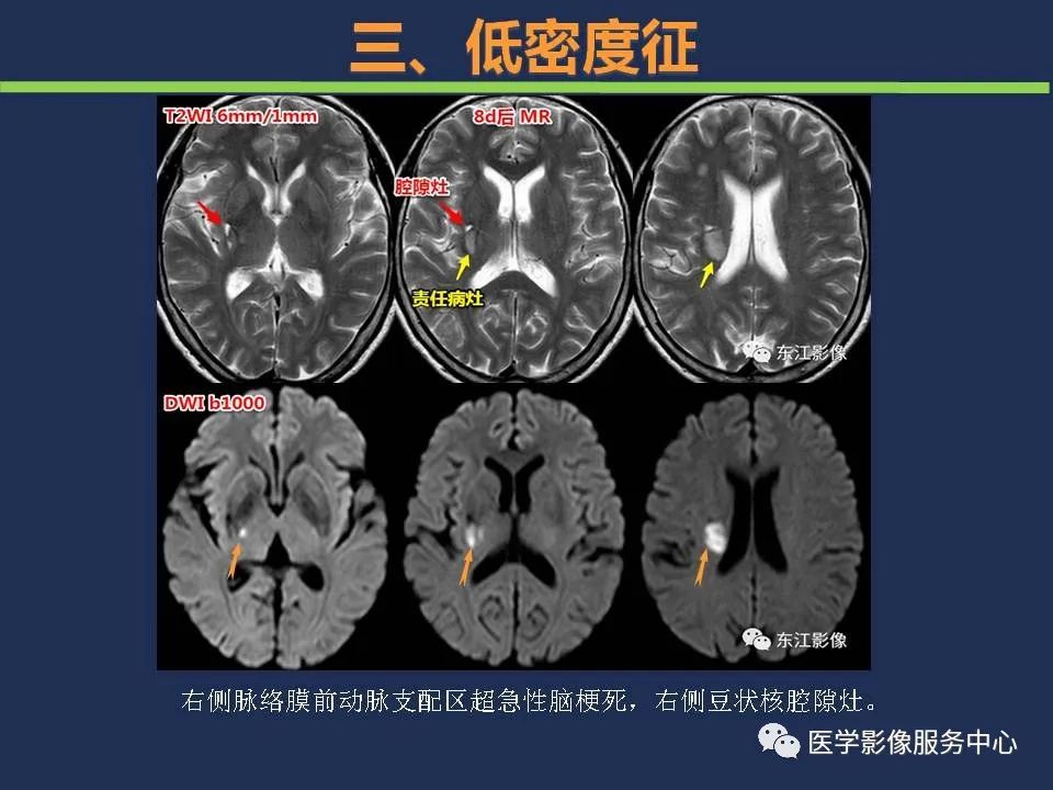 影像PPT - 【PPT】超早期脑梗死CT征象-46