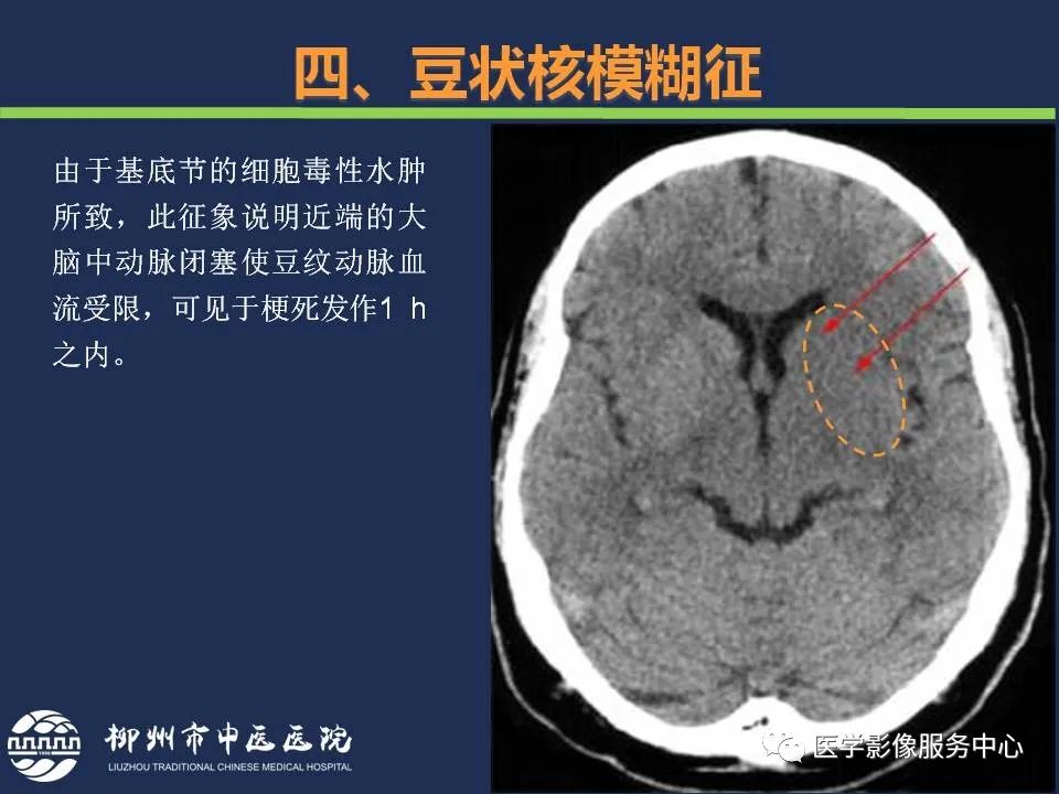 影像PPT - 【PPT】超早期脑梗死CT征象-47