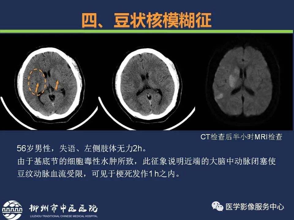 影像PPT - 【PPT】超早期脑梗死CT征象-48