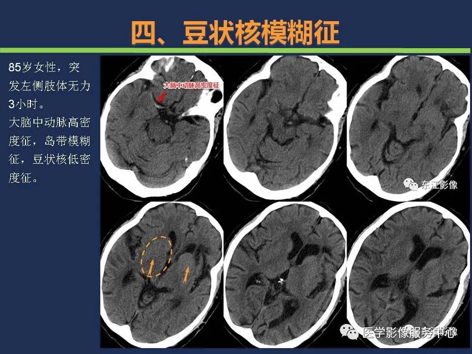 影像PPT - 【PPT】超早期脑梗死CT征象-49