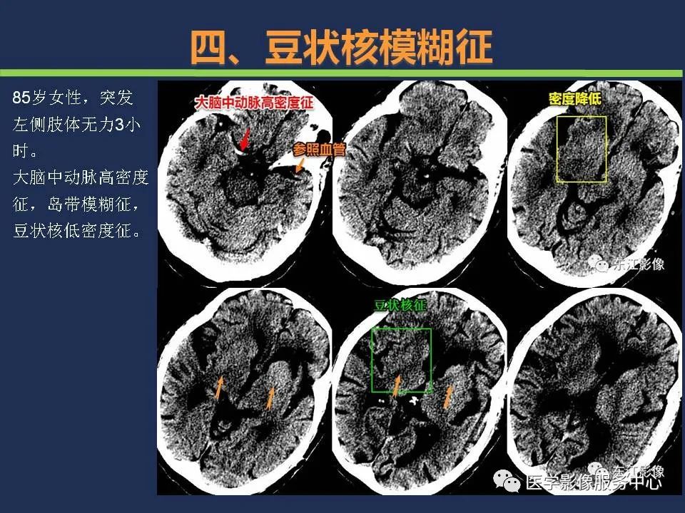 影像PPT - 【PPT】超早期脑梗死CT征象-50