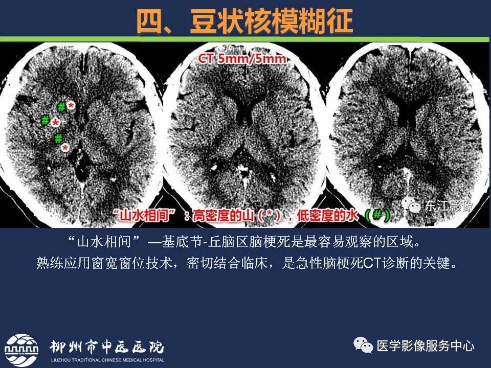 影像PPT - 【PPT】超早期脑梗死CT征象-51