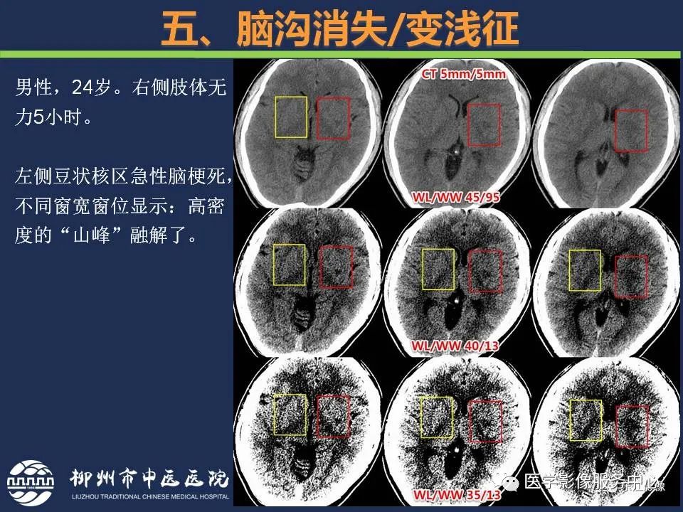 影像PPT - 【PPT】超早期脑梗死CT征象-52