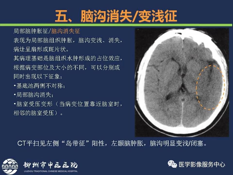 影像PPT - 【PPT】超早期脑梗死CT征象-53