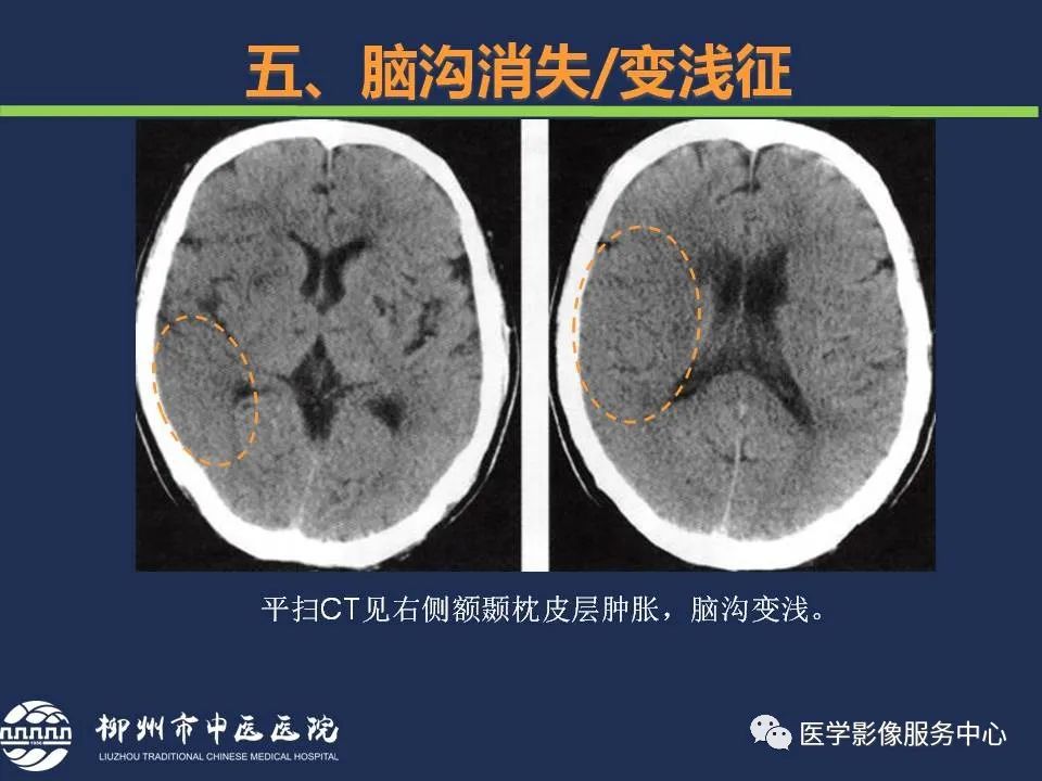 影像PPT - 【PPT】超早期脑梗死CT征象-54