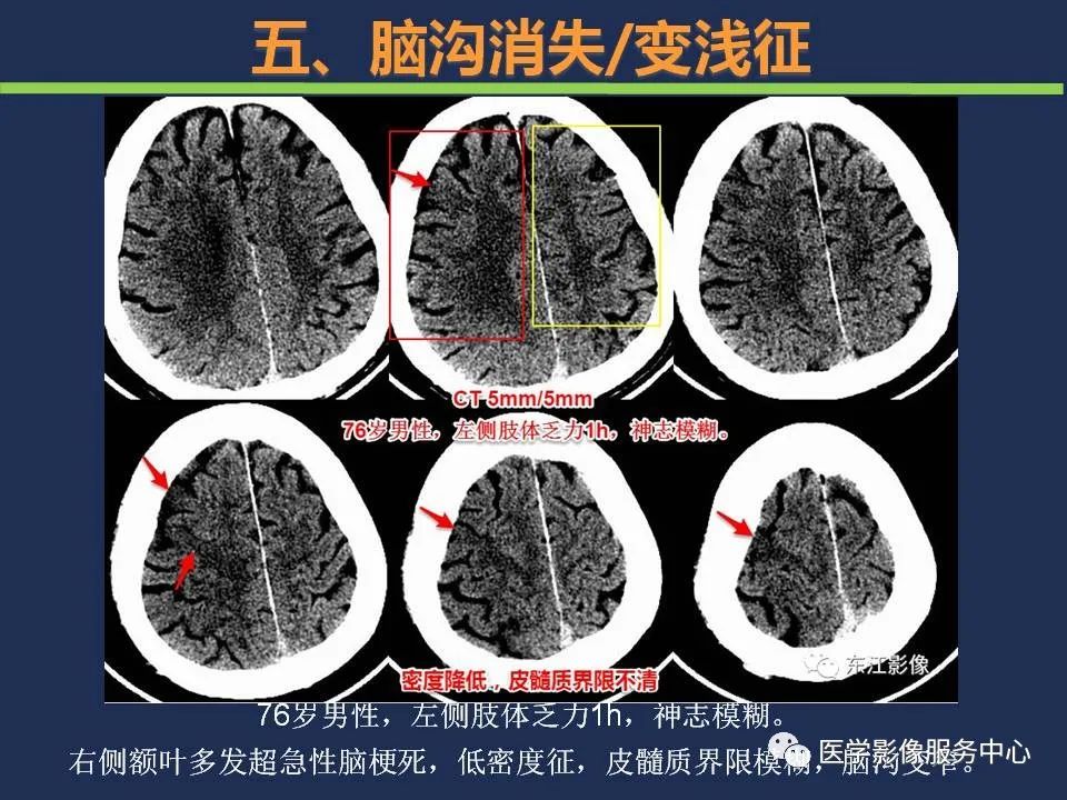 影像PPT - 【PPT】超早期脑梗死CT征象-55