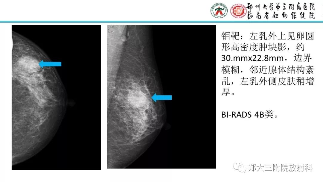 影像PPT - 【PPT】乳腺MRI诊断原则及常见病例-15