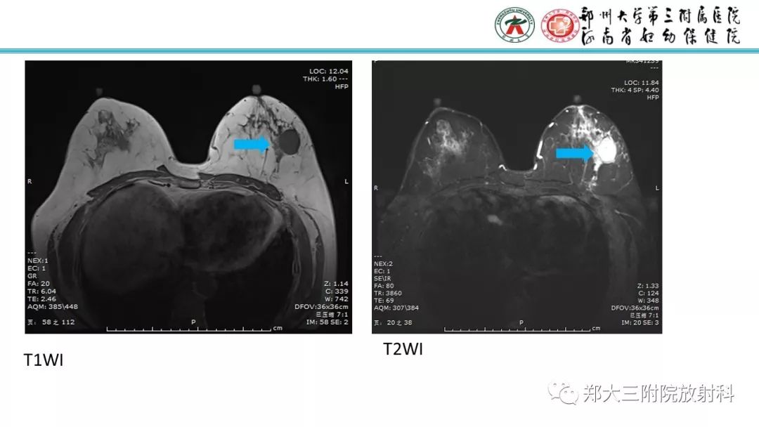 影像PPT - 【PPT】乳腺MRI诊断原则及常见病例-16