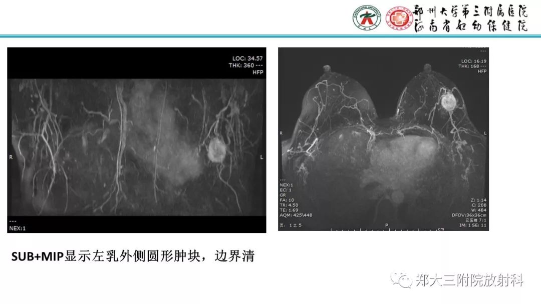 影像PPT - 【PPT】乳腺MRI诊断原则及常见病例-17