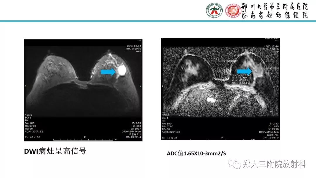 影像PPT - 【PPT】乳腺MRI诊断原则及常见病例-18