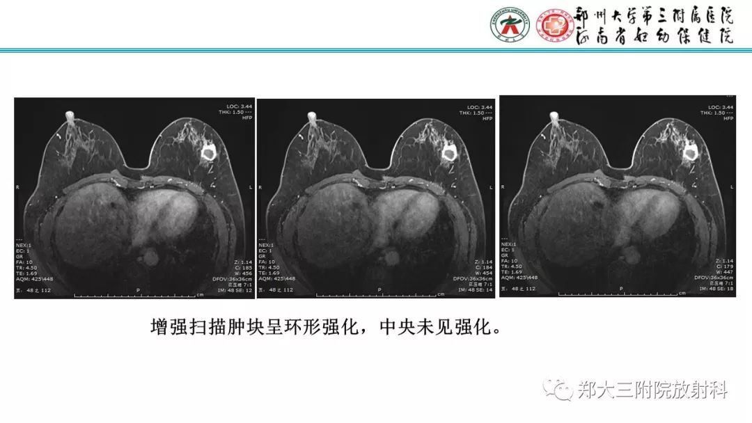 影像PPT - 【PPT】乳腺MRI诊断原则及常见病例-19
