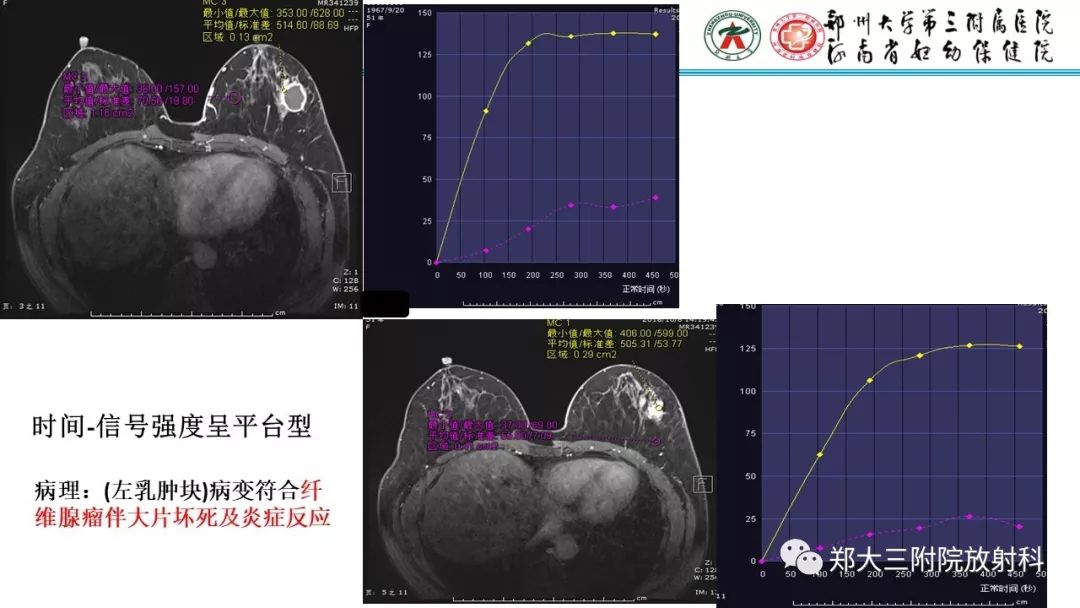 影像PPT - 【PPT】乳腺MRI诊断原则及常见病例-20
