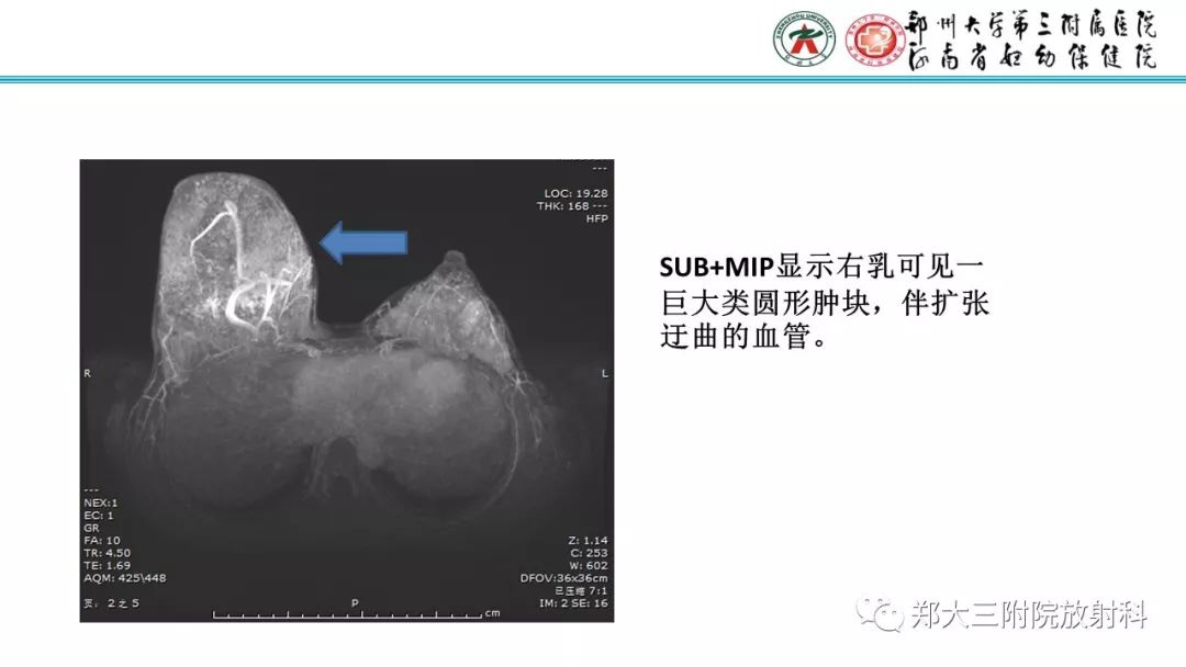 影像PPT - 【PPT】乳腺MRI诊断原则及常见病例-25