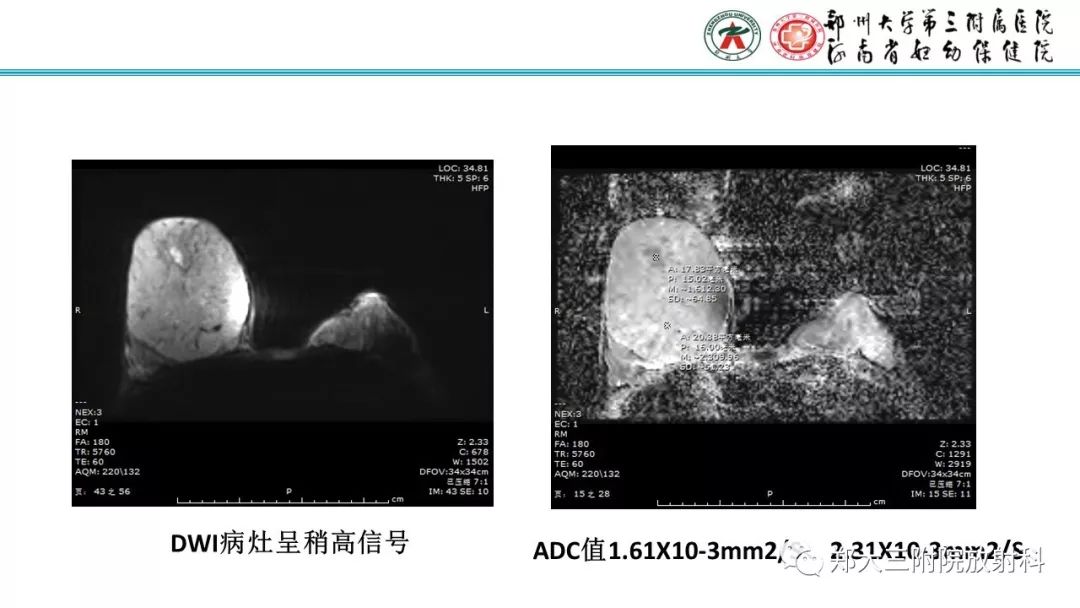 影像PPT - 【PPT】乳腺MRI诊断原则及常见病例-26