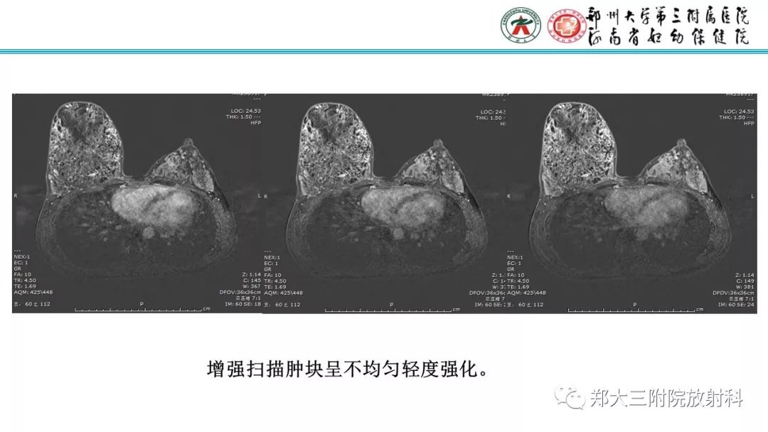 影像PPT - 【PPT】乳腺MRI诊断原则及常见病例-27