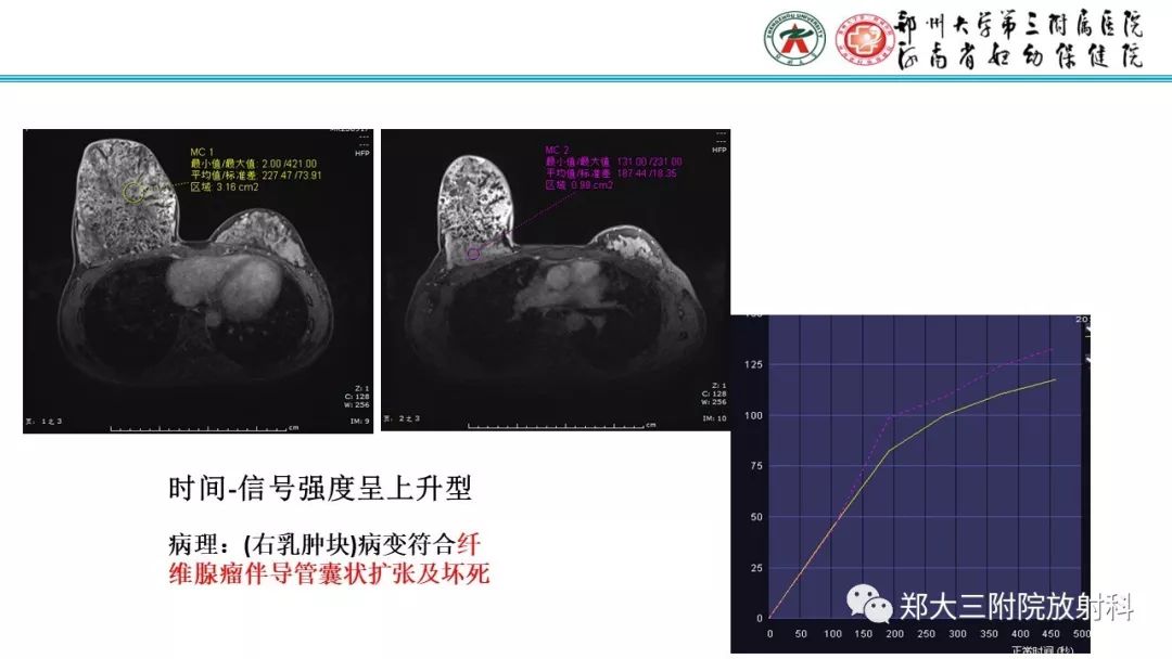 影像PPT - 【PPT】乳腺MRI诊断原则及常见病例-28