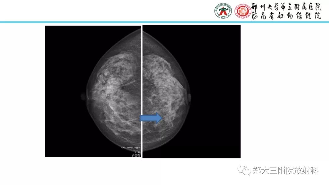 影像PPT - 【PPT】乳腺MRI诊断原则及常见病例-31