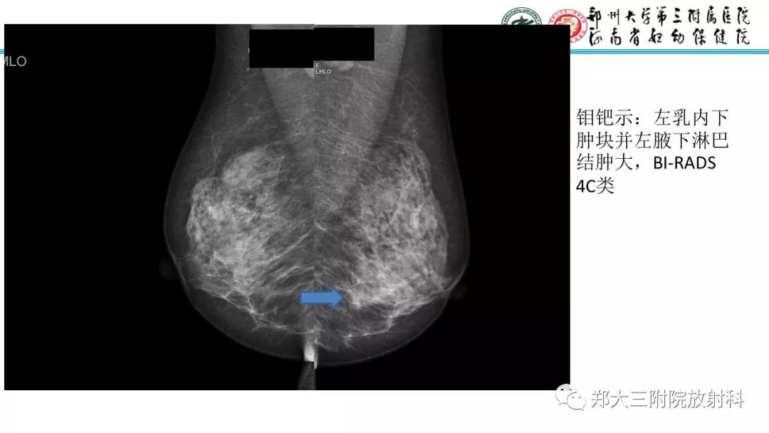 影像PPT - 【PPT】乳腺MRI诊断原则及常见病例-32