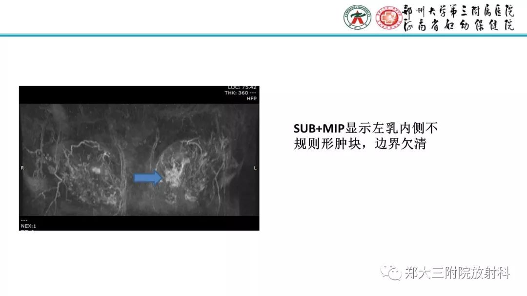 影像PPT - 【PPT】乳腺MRI诊断原则及常见病例-34