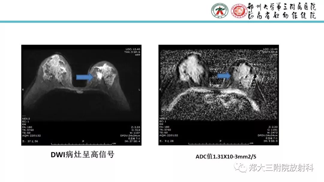 影像PPT - 【PPT】乳腺MRI诊断原则及常见病例-35