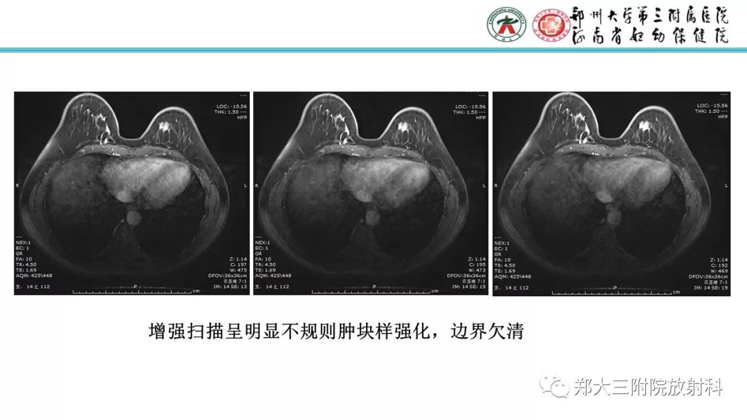 影像PPT - 【PPT】乳腺MRI诊断原则及常见病例-36