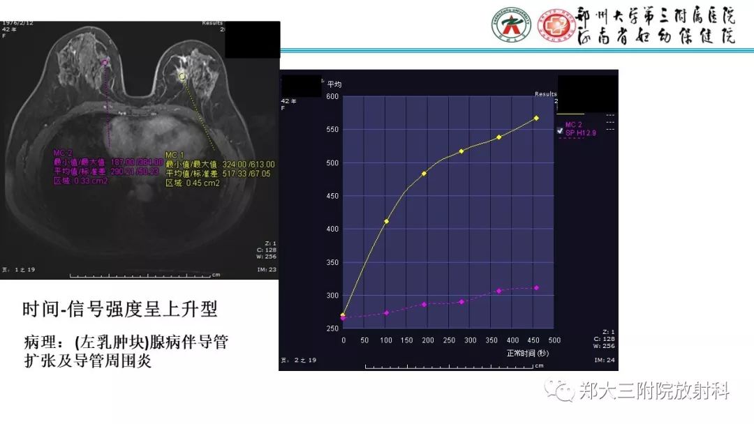 影像PPT - 【PPT】乳腺MRI诊断原则及常见病例-37