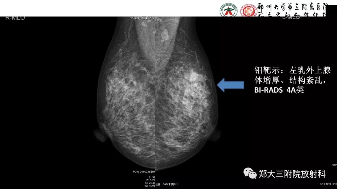 影像PPT - 【PPT】乳腺MRI诊断原则及常见病例-41