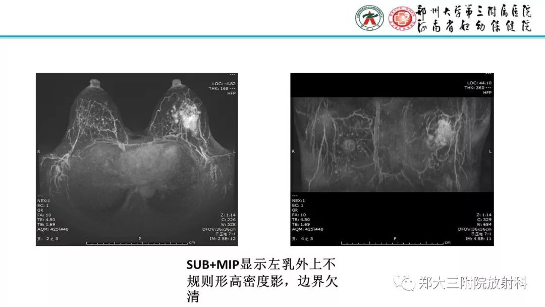 影像PPT - 【PPT】乳腺MRI诊断原则及常见病例-43