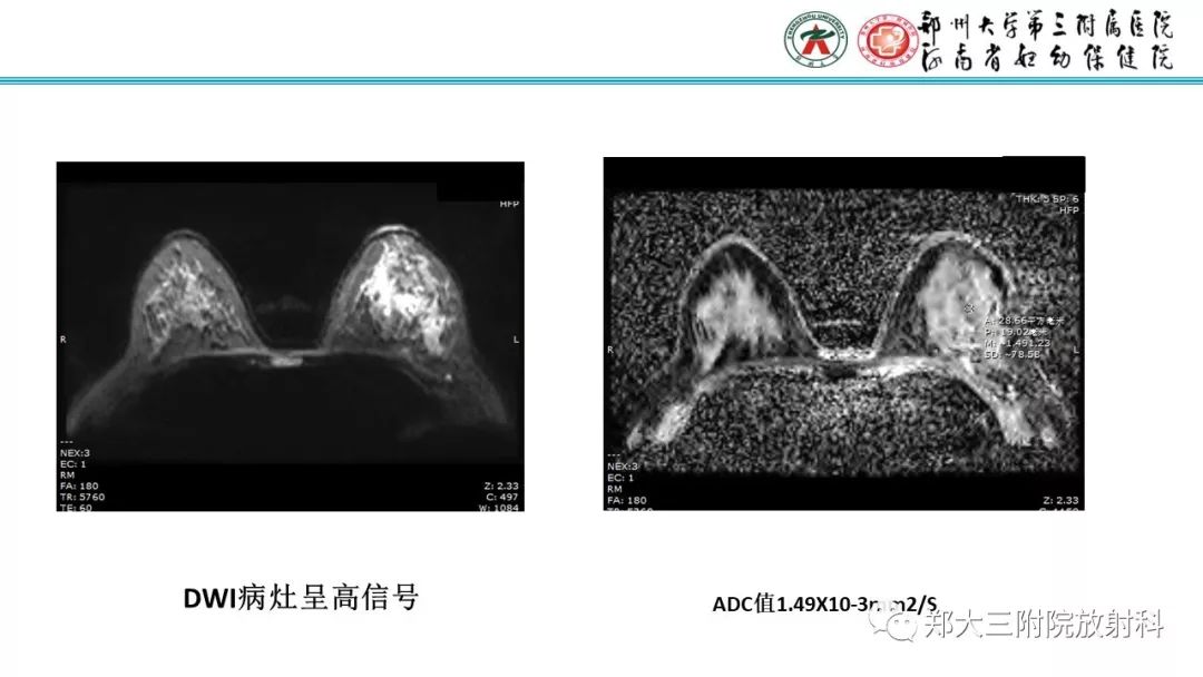 影像PPT - 【PPT】乳腺MRI诊断原则及常见病例-44