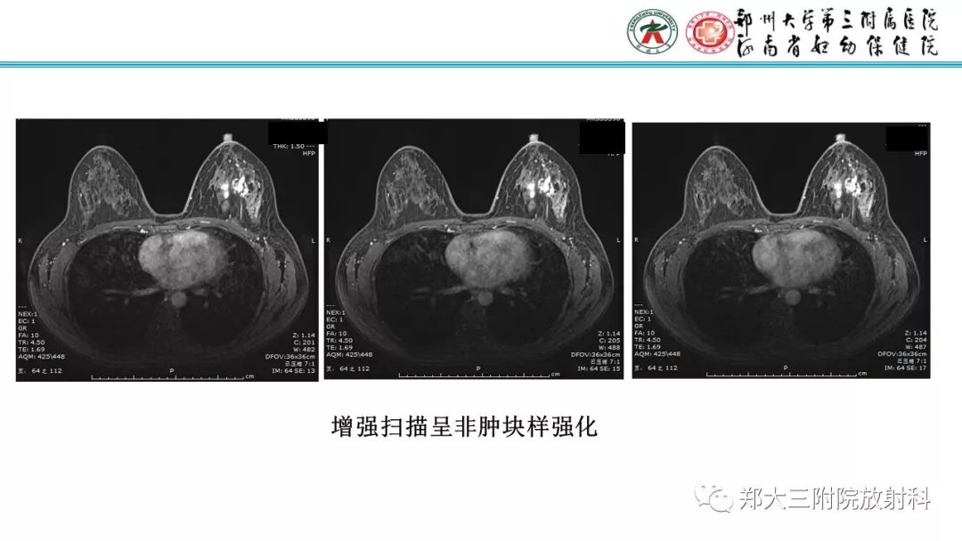 影像PPT - 【PPT】乳腺MRI诊断原则及常见病例-45