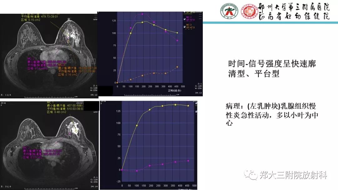 影像PPT - 【PPT】乳腺MRI诊断原则及常见病例-46