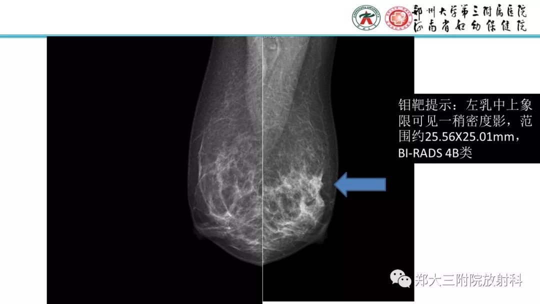 影像PPT - 【PPT】乳腺MRI诊断原则及常见病例-50