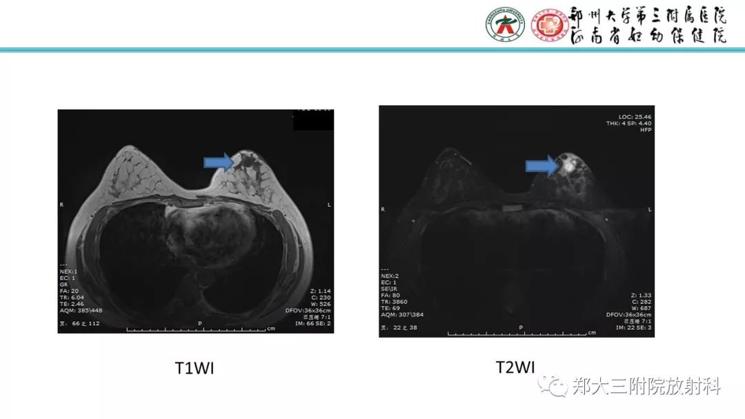 影像PPT - 【PPT】乳腺MRI诊断原则及常见病例-51
