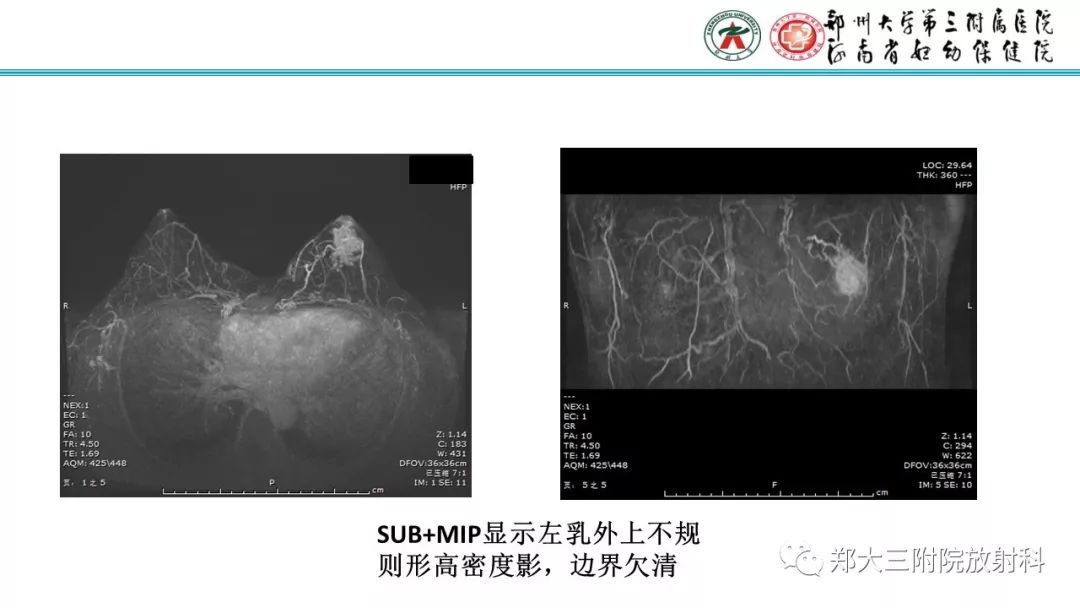 影像PPT - 【PPT】乳腺MRI诊断原则及常见病例-52